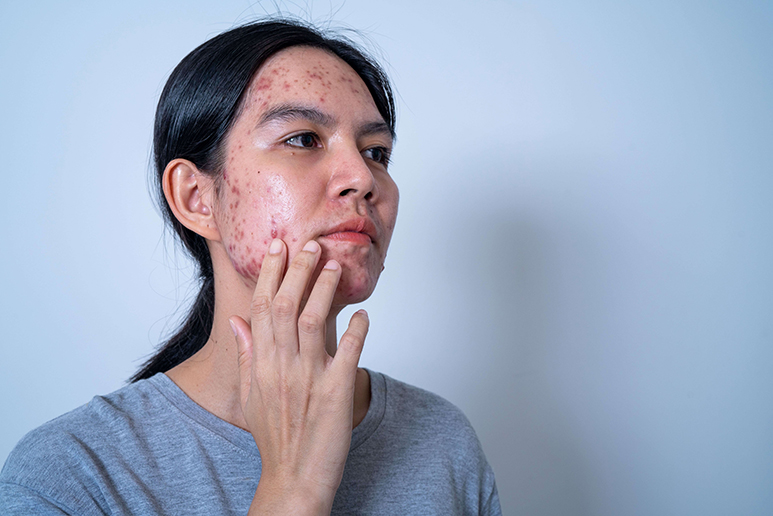 5 Ways Food Sensitivities and Allergies May Lead to Acne